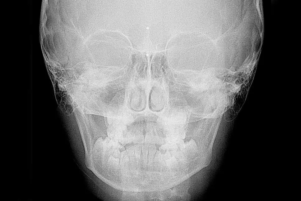 teleradiografia latero laterale