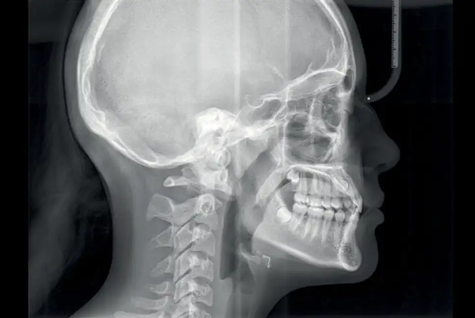 teleradiografia latero laterale